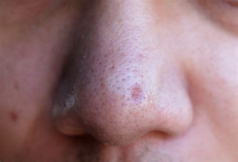 10 Easy and Natural Remedies for Large Pores on Nose- Charlies