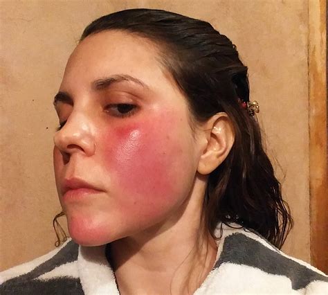 Study: Burning and Stinging Are Neglected but Important Symptoms in Managing Rosacea | Rosacea.org