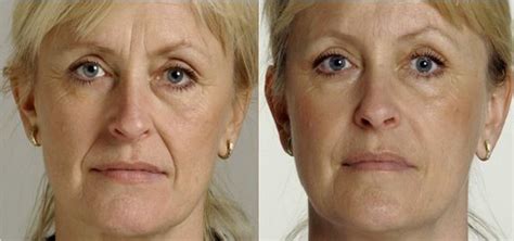 Wrinkle Fillers – Best Deep, Instant Injectable, Topical & OTC Face Wrinkle Filler Before and ...