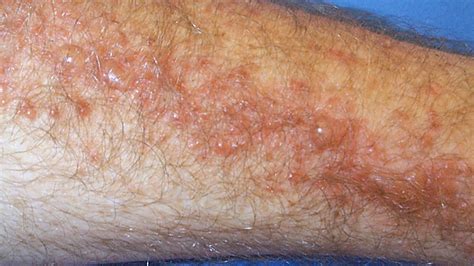 Poison ivy rash images - lasopahowto