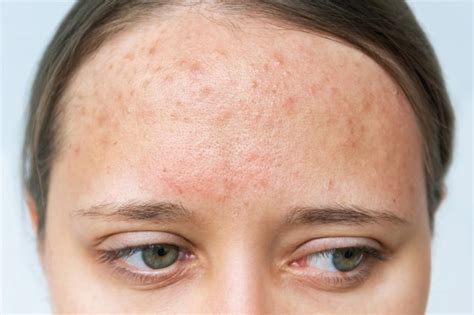 Premium Photo | Close up of red rash on a forehead. Cropped shot of a ...