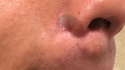 Sebaceous Cysts On Lips | Lipstutorial.org