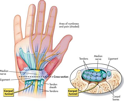 Carpal Tunnel Syndrome | Osteohealth