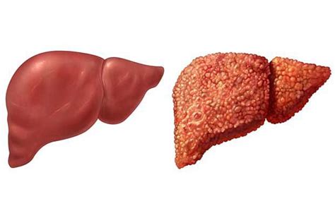 Is liver tissue hardness 17.7KPa dangerous? | Vinmec