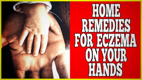 Home Remedies For Eczema On Hands - Clinton Conley