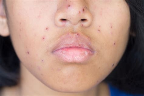 Outrageous Tips About How To Avoid Chicken Pox Scars - Treecurve