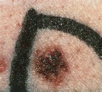 Dysplastic Nevus Removal