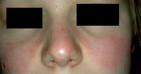 👉 Lupus Rash - Pictures, Symptoms, Causes, Treatment (December 2021)