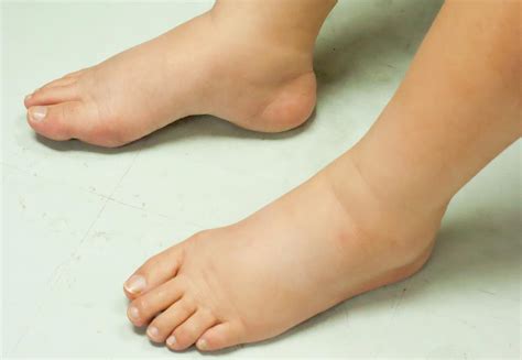 Who Else Wants Info About How To Reduce Swelling Feet - Policebaby25