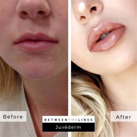 Juvederm Ultra Plus Vs Voluma Lips | Lipstutorial.org