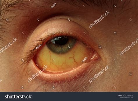 Yellow Staining Sclera Eye Diseases Liver Stock Photo (Edit Now) 1419773324