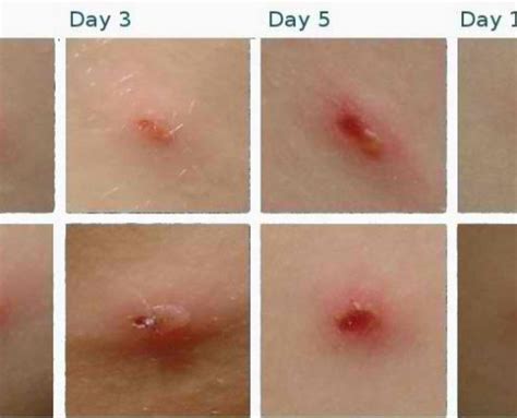 Outrageous Tips About How To Avoid Chicken Pox Scars - Treecurve