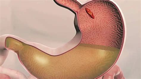 What is Melanotic stool? – Useful Info Daily