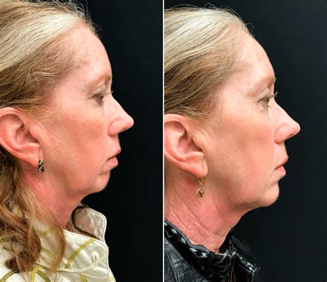 NonSurgical Chin Augmentation with Voluma Filler Injections Before & After Photos New Jersey ...