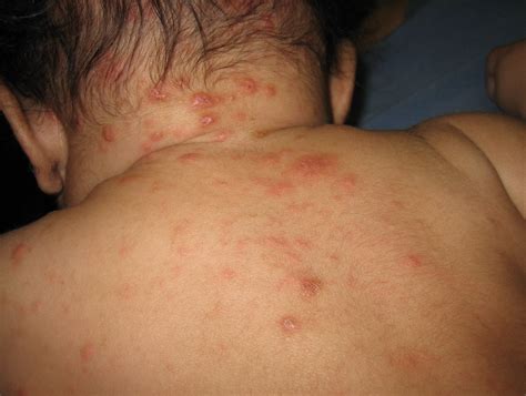 Scabies Rash On Stomach