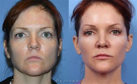 Liquid Facelift Photos Beautiful Results Rejuvent Scottsdale