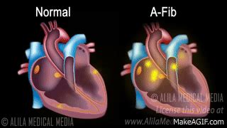 Atrial Fibrillation Anatomy, ECG and Stroke, Animation. on Make a GIF