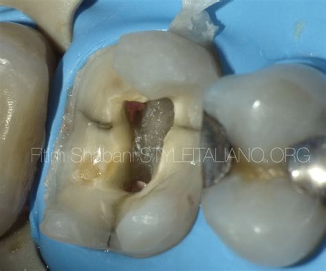 Treatment of a cracked tooth - Style Italiano Endodontics