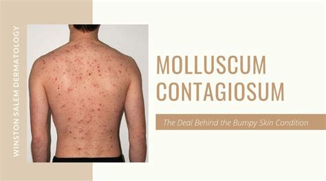 Molluscum Contagiosum – The Deal Behind the Bumpy Skin Condition | Winston Salem Dermatology