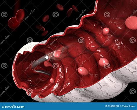 3d Illustration of Removal of a Colonic Polyp with a Electrical Wire Loop during a Colonoscopy ...