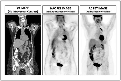 1.1 What is a PET Scan? - HOME - PET/CT MD