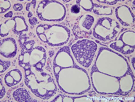 adenoid cystic carcinoma pathology