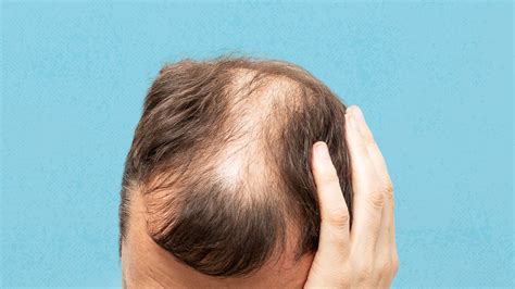 What Is Alopecia Areata? Symptoms, Causes, Diagnosis, and Treatment | Christ Memorial