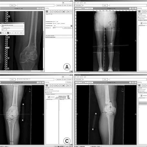 Radiographic images of case No. 9: 13° of valgus hip-knee-ankle axis in... | Download Scientific ...