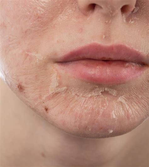 Skin Peeling: Causes, Symptoms, And How To Reduce It