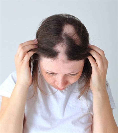 Alopecia Areata Hair Loss – Causes, Symptoms, & Treatments