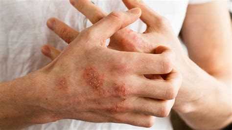 7 Best Natural Home Remedies & Treatment for Eczema & Psoriasis Relief