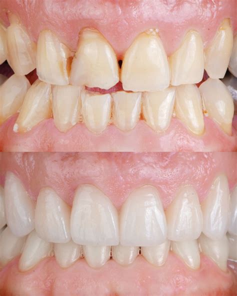 Veneers before / after | Perfect smile, Teeth, Veneers