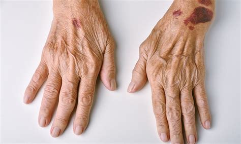 Elderly Bruised Skin: What Causes It and How to Prevent It - Elderly Guides