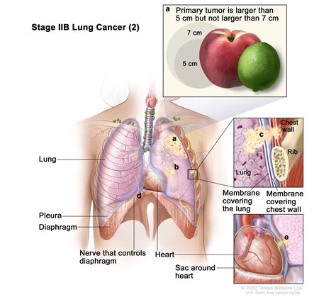 Non-Small Cell Lung Cancer | Vanderbilt-Ingram Cancer Center