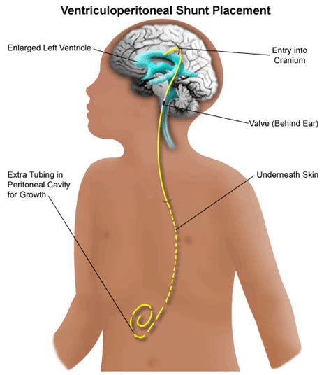 Shunt surgery | Children's Health Queensland