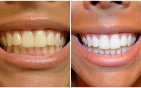 Are Teeth Whitening Strips Effective? | New Jersey Orthodontics