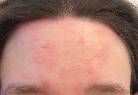 Alcohol Seizures Treatment: Eczema On Forehead Treatment