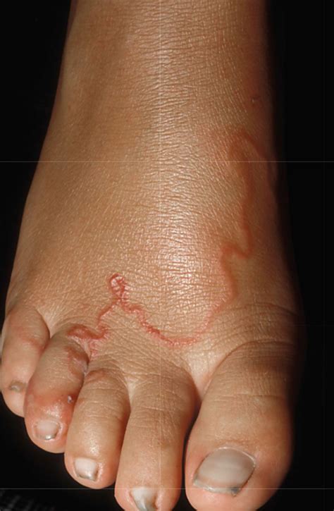 ACD A-Z of Skin - Cutaneous Larva Migrans