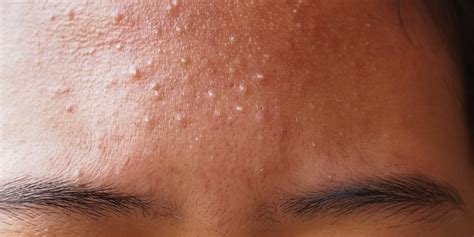 Forehead Acne (Pimple): Causes, Treatments, Prevention, And Results