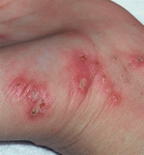 Scabies Rash Pictures