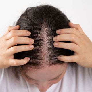 Female Pattern Hair Loss (Androgenetic Alopecia) - Hill Center For Dermatology PC | Golden, CO ...