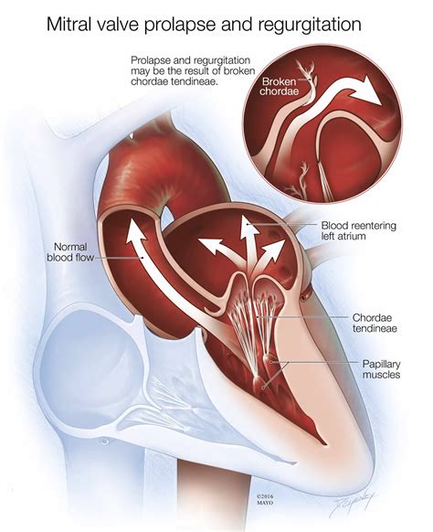 Mitral Valve | Images and Photos finder