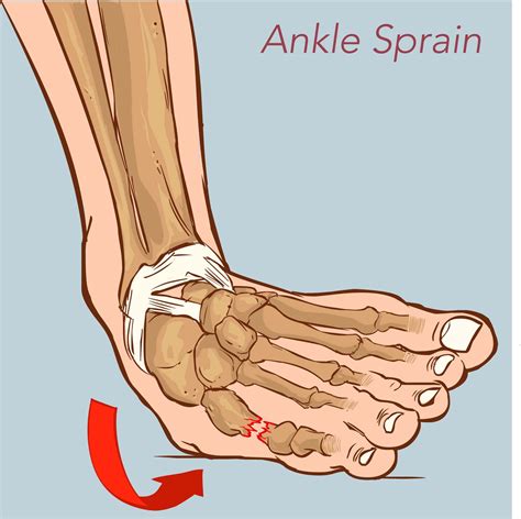 Illustration Showing A Sprained Ankle Ankle Sprain Symptoms Sprained ...