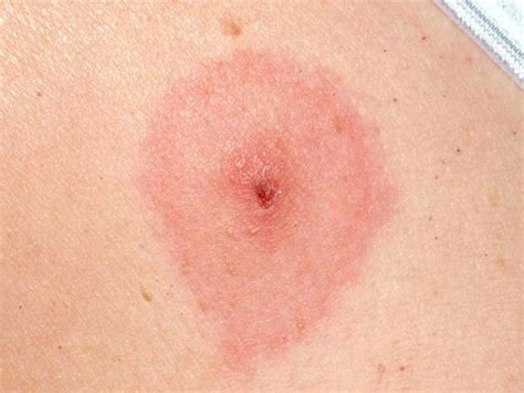 Tick bite rash – how to recognize the symptoms, treatment tips