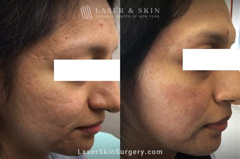 Acne Scars Treatment in New York - Laser NY