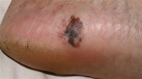 Foot Melanoma: Symptoms, Causes, and Treatments