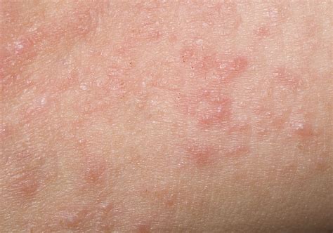 Contact Dermatitis: Overview and More