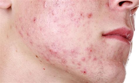 ACNE and HIDRADENITIS SUPPURATIVA – Arlington Skin Doctor