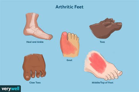 Psoriatic Arthritis In The Feet: Symptoms, Treatment, Home, 59% OFF