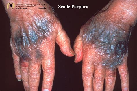 Senile Purpura: Bruising In The Elderly... - Academic Dermatology of Nevada